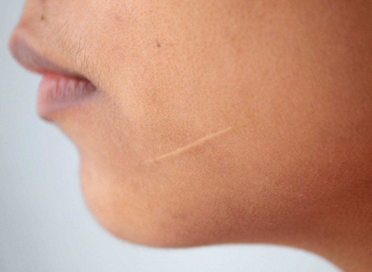 Scars on the face