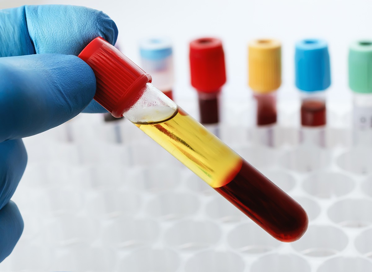 Blood,Drawn,From,A,Patient,With,Serum,doctor,hospital